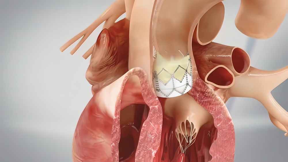 heart valve replacement surgery