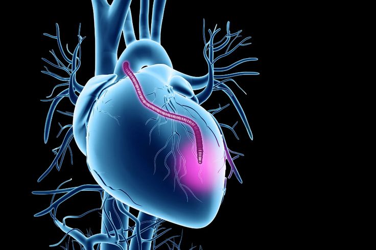 heart bypass surgery