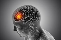 brain stroke treatment