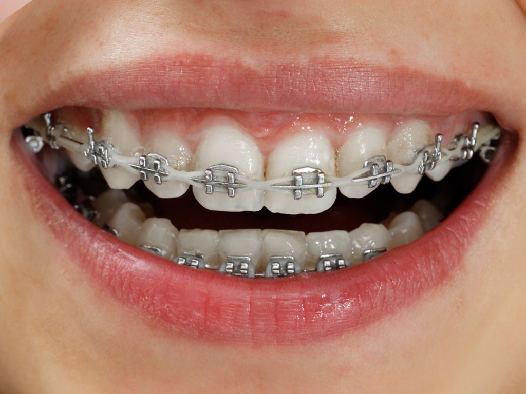 braces treatment cost