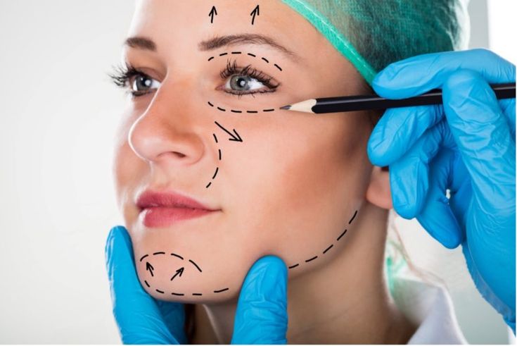 facelift surgery