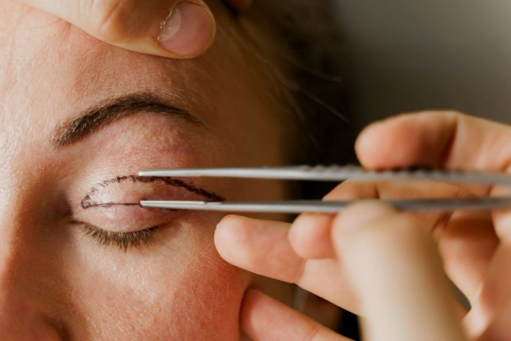 blepharoplasty