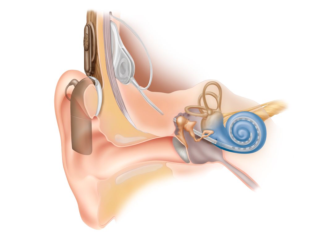 cochlear implant treatment