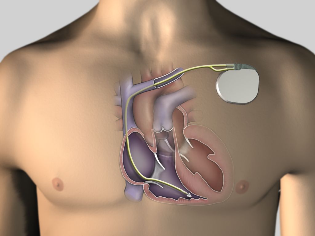 pacemaker implant surgery