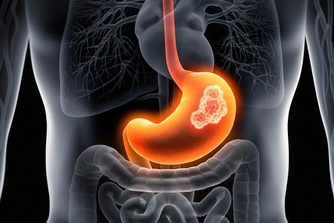 stomach cancer treatment