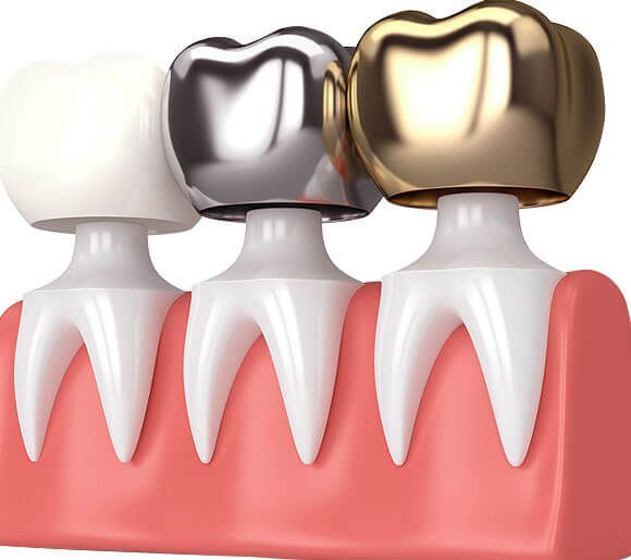 dental crown and bridge treatment