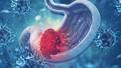 stomach cancer treatment