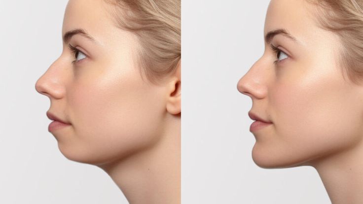 chin augmentation