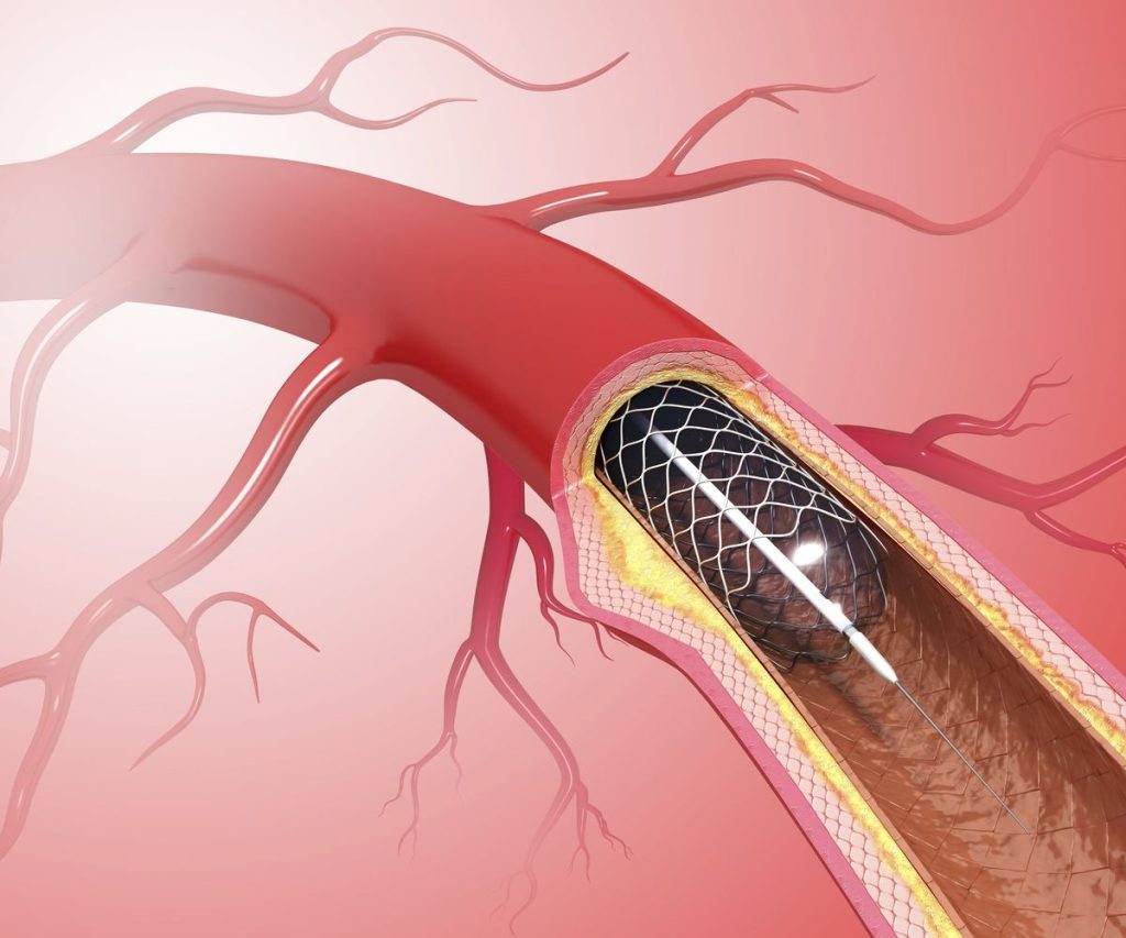 heart stent placement surgery