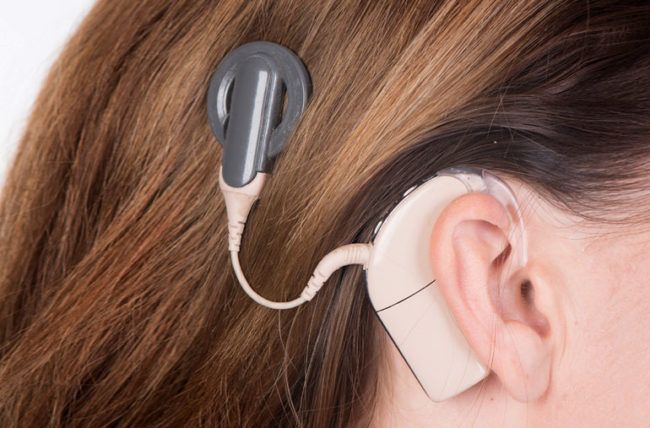 cochlear implant treatment