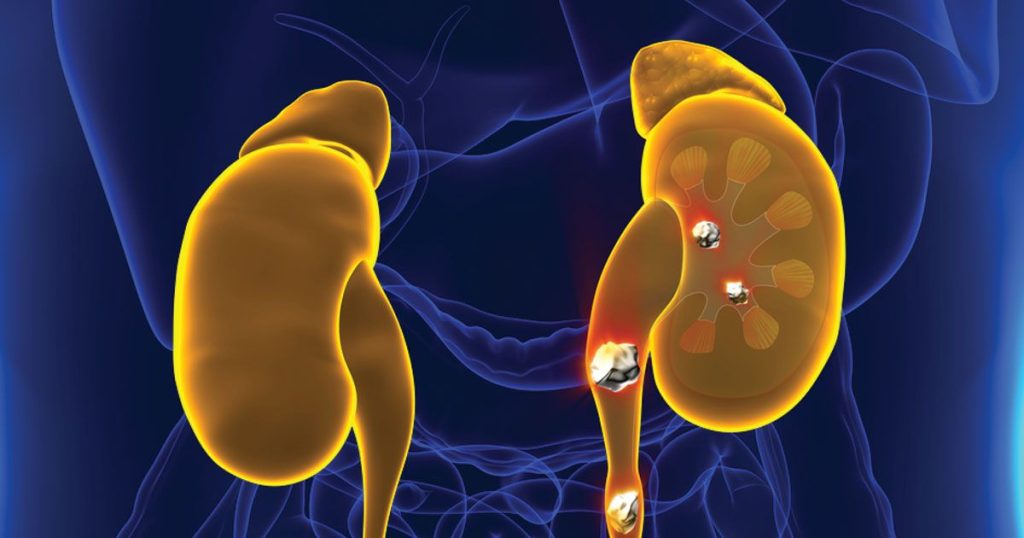 kidney stone laser
