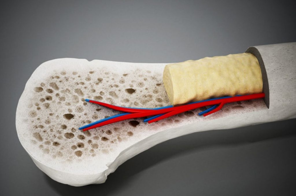 bone marrow transplant