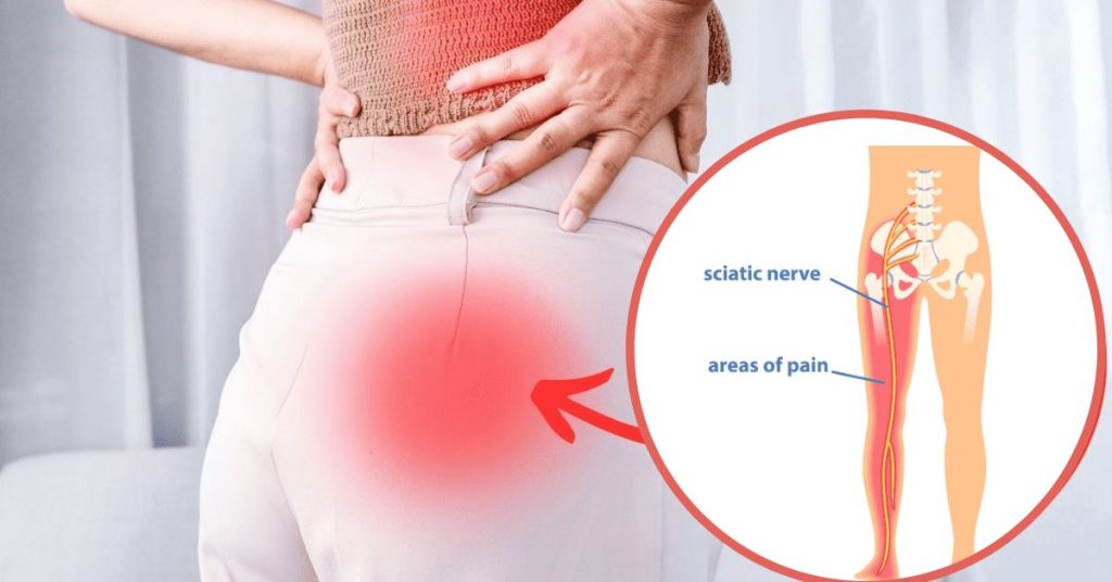 sciatica pain treatment