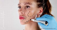 facelift surgery