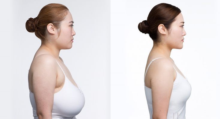Breast Implant