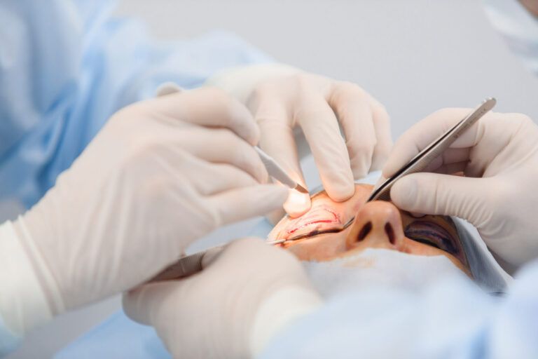 blepharoplasty