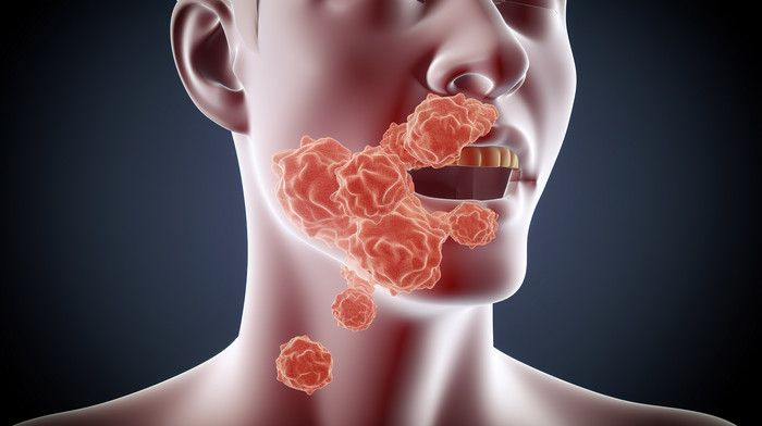 mouth cancer treatment