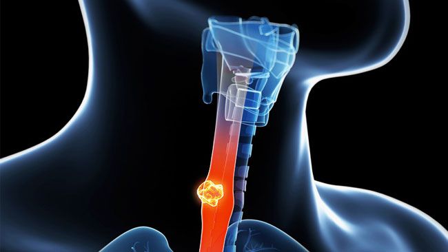 esophageal cancer treatment