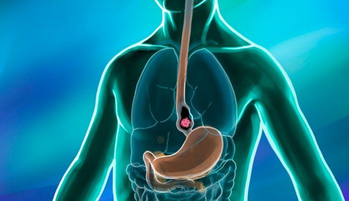 esophageal cancer treatment